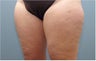 Smartlipo