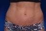 Smartlipo 