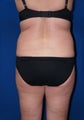 Smart Lipo for back rolls and "muffin top"