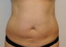 Smart Lipo