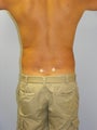 SMARTLipo MPX