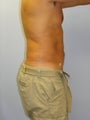 SMARTLipo MPX