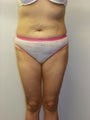 SMARTLIPO MPX