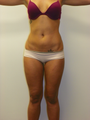  SMARTLIPO MPX
