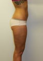 SMARTLIPO MPX