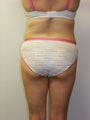 SMARTLIPO MPX