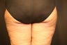 Smartlipo MPX