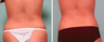 SmartLipo MPX