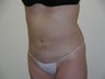 smartlipo of abdomen