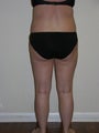 SMARTLIPO