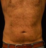 SmartLipo MPX