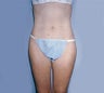 Smart Lipo
