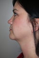 SmartLipo to the neck