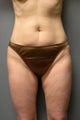 SmartLipo