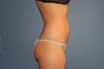 Smart Lipo MPX
