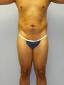 MPX SmartLipo