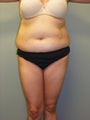 SMARTLIPO MPX