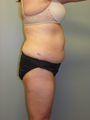 SMARTLIPO MPX