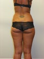 SMART LIPO MPX