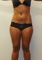  SMARTLIPO MPX