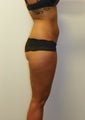 SMARTLIPO MPX