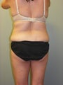 SMARTLIPO MPX