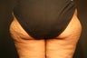 Smartlipo MPX