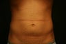 Smartlipo