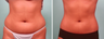 SmartLipo MPX