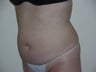 smartlipo of abdomen