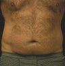 SmartLipo MPX