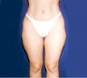 Smartlipo