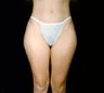 Smart Lipo