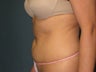 Smartlipo of the Abdomen