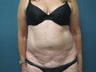 Smartlipo of the Abdomen