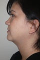 SmartLipo to the neck
