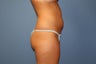 Smart Lipo MPX