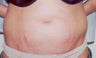 Laser Skin Resurfacing with Smartxide DOT Therapy