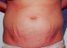 Laser Skin Resurfacing with Smartxide DOT Therapy
