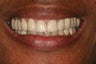 Smile Makeover
