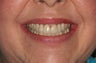 Smile Makeover