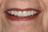 Esthetic Reconstruction