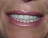 Sedation Dentistry