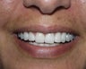 Crowns, Implants and Veneers