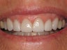 Smile Makeover