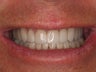 Full Mouth Makeover