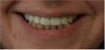 Smile Makeover with crowns and veneers