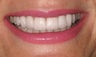 Smile Makeover