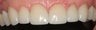 Porcelain Veneers and Crowns