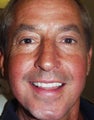 Smile Makeover